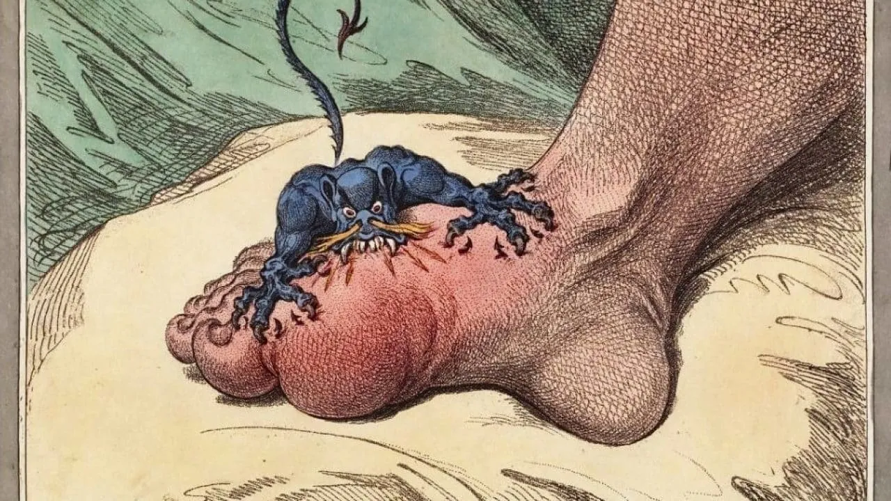 The Gout, a satirical etching by James Gillray (1799)