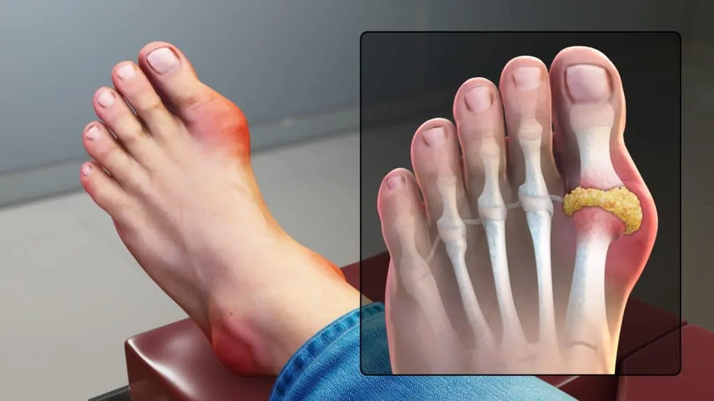 Gout affecting the big toe, the most commonly involved joint