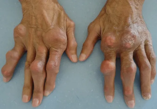 Hands with longstanding gout deposits forming tophi